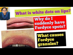 fordyce spots on your lips fast