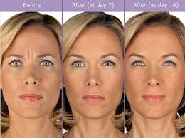 botox cosmetic before after photos