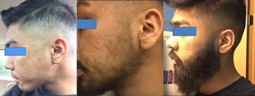How to double your minoxidil beard growth! Minoxidil And Beard Growth Rogaine For Facial Hair Stimulation