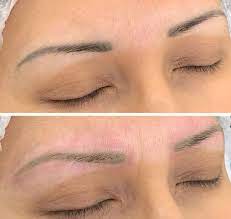laser removal of eyebrow microblading