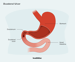 duodenal ulcer symptoms causes risk