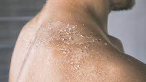 cure fungal infections of the skin