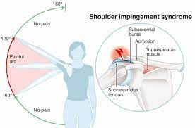 shoulder impingement exercises