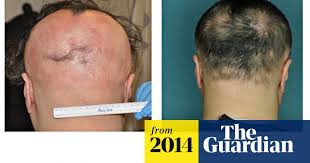 Alopecia totalis — total loss of the hair on the scalp. Alopecia Sufferers Given New Treatment Hope With Repurposed Drug Medical Research The Guardian