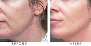 lines gone instantly with juvederm