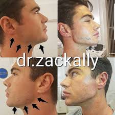 Jawline sculpting with dermal filler is one of the most popular treatments at contour clinics. Masculinisation Learn How To Artistically Sculpt A New Jawline In 10 Minutes With No Downtime And Immediate Results On Facial Contouring Facial Fillers Jawline