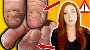 breaking news nail allergies your