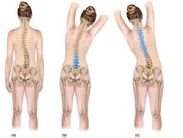 a right convexity lumbar scoliosis and left convexity thoracic scoliosis b right lateral flexion stretch that decreases the lumbar scoliotic curve
