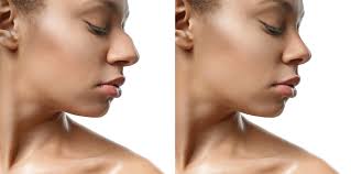how long is recovery from rhinoplasty