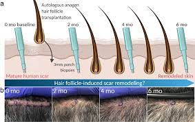 anagen hair follicles transplanted into