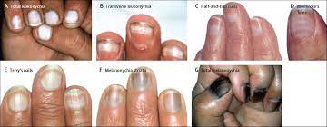 nail toxicities induced by systemic