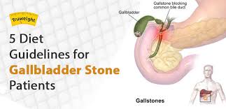 5 Diet Guidelines For Gallbladder Stone Patients Truweight