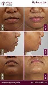 lip reduction surgery cost in mumbai