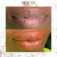 dark lip color correction treatment