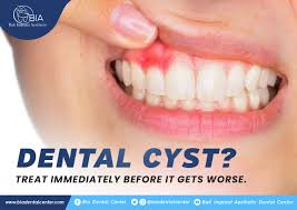 dental cyst treat imately before