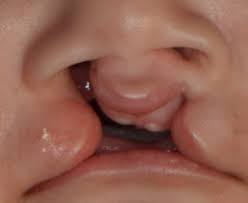 cleft lip and palate in children