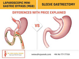 laparoscopic mini gastric byp mgb