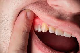 is gum disease conious is gum