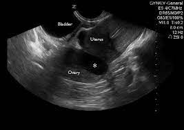 The sound waves create a picture on a video monitor. Abdominal Pain In Nonpregnant Female Patients 2014 04 06 Ahc Media Continuing Medical Education Publishing