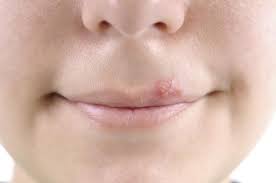 how to get rid of a cold sore causes