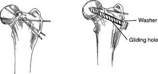 fractures of the femur veterian key