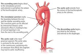 Thoracic Aortic Aneurysm How To Counsel When To Refer