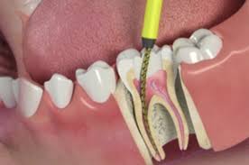 tooth abscess treatment symptoms