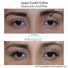 uneven eyes when treatment is needed