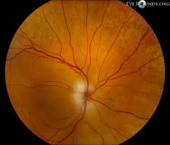 Treatment of optic neuritis with intrevenous megadose corticosteroids: Arteritic Anterior Ischemic Optic Neuropathy Aaion Secondary To Giant Cell Arteritis Gca