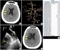 Cva is an adjustment to the fair value (or price) of derivative instruments to account for counterparty thus, cva is commonly viewed as the price of ccr. Cerebrovascular Accident In A Patient With Left Ventricular Assist Device And Therapeutic Inr Should Left Atrial Appendage Be Routinely Closed Sciencedirect