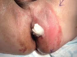 drainage of a peri abscess