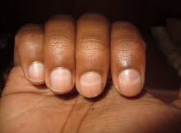 fingernail changes in ibs gluten