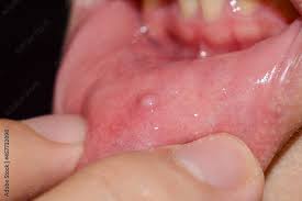 small vesicle lesion at lower lip stock