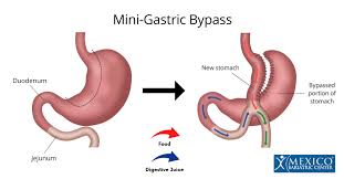 mini gastric byp vs mini gastric