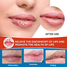 3pcs cold sores lip cheilitis treatment
