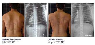 15 degree scoliosis what treatment is