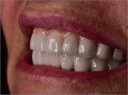 full mouth dental implants in bangalore