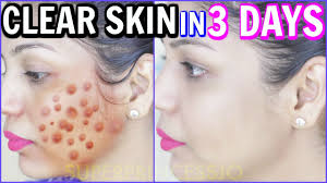 how to get clear skin in 3 days