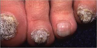 onychomycosis tinea unguium nail