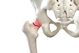 should you repair a fractured hip or