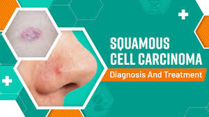 squamous cell carcinoma diagnosis and
