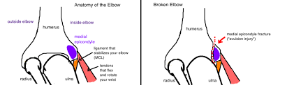To evaluate and when to operate. Kids Broken Elbow Medial Epicondyle Fracture Bone Talks