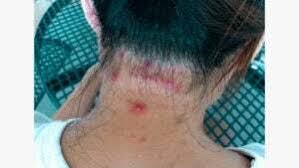 ps on the scalp pictures causes