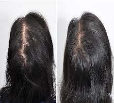 affordable prp treatment for hair loss
