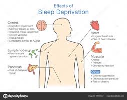 Diagram Effects Sleep Deprivation Illustration Disease