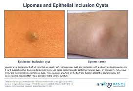 lipomas epithelial inclusion cysts