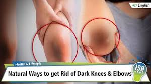 home remes to get rid of dark knees