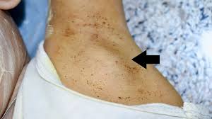 hard lump under the skin causes and