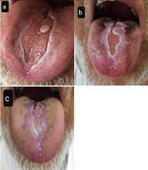 tongue ulcer in a patient with covid 19