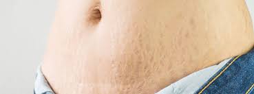 vancouver stretch mark treatments